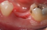 4 settimane dopo l’estrazione del dente; in molti casi è possibile (se richiesto e valutata l’idoneità del caso) inserire l’impianto subito dopo l’estrazione del dente saltando una fase chirurgica ma non è la routine
