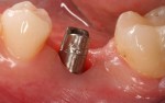 moncone collegato all’impianto e sul quale verrà applicata la corona dentale