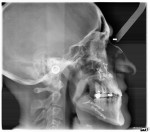 Teleradiografia 3 mesi dopo l'intervento di avanzamento della mascella e arretramento-rotazione della mandibola