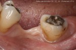 dopo raddrizzamento del molare con apparecchio ortodontico