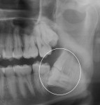 giudizio inferiore sinistro incluso con dente soprannumerario