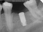radiografia endorale dopo il raddrizzamento del molare e l’inserimento dell’impianto