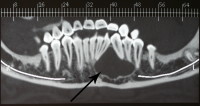 Tomografia Computerizzata (TC) con Dentascan - cisti mandibolare