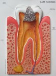 endodonzia - devitalizzazione - terapia canalare