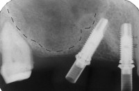 dopo l'inserimento degli impianti la radiografia di controllo evidenzia il loro voluto disparallelismo; quello più a destra è parallelo al dente adiacente mentre quello al centro è inclinato per evitare la cavità del seno mascellare (tratteggiato)