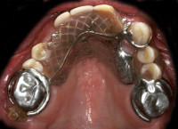 situazione iniziale; arcata superiore con 3 denti residui validi che sostengono una protesi mobile scheletrata totalmente incongrua