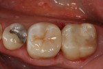 intarsio cementato sul molare al centro e ricostruzione diretta del molare a dx