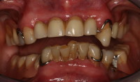 situazione iniziale: sono presenti protesi mobili parziali deteriorate e denti residui mobili e con profonde carie radicolari