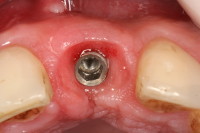 dopo terapia ortodontica per il riallineamento dentale e ridimensionamento dello spazio, è stato inserito un impianto e ottenuto il condizionamento gengivale ottimale