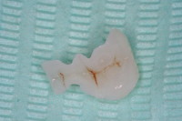 modellazione in laboratorio dell'intarsio cioè della parte mancante del dente