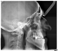 Teleradiografia che evidenzia l'alterato rapporto fra mandibola e mascella