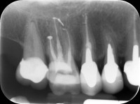 terapia canalare molare superiore - dopo