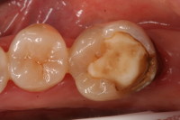 molare con vecchia otturazione infiltrata da carie con infezione della polpa dentaria e dolore