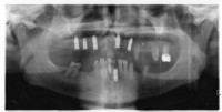 radiografia panoramica digitale (OPT)