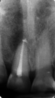 lesione intorno all'apice di un incisivo più volte trattato endodonticamente