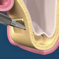 cavità del seno mascellare, sopra l’arcata dentaria senza denti