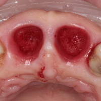 alveoli dentari post estrazione